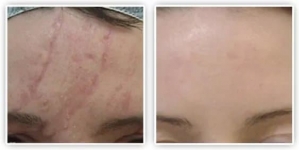 СКАР ГЕЛЬ – (SCAR GEL GIFFARINE) - ДЛЯ УДАЛЕНИЯ ШРАМОВ, РУБЦОВ, ШРАМОВ ПОСЛЕ КЕСАРЕВА СЕЧЕНИЯ, ТЕМНЫХ ПЯТЕН - 15 ГР. ТАИЛАНД