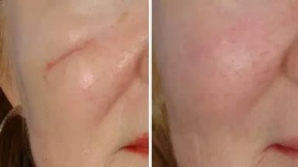 СКАР ГЕЛЬ – (SCAR GEL GIFFARINE) - ДЛЯ УДАЛЕНИЯ ШРАМОВ, РУБЦОВ, ШРАМОВ ПОСЛЕ КЕСАРЕВА СЕЧЕНИЯ, ТЕМНЫХ ПЯТЕН - 15 ГР. ТАИЛАНД