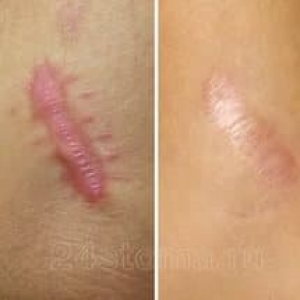 СКАР ГЕЛЬ – (SCAR GEL GIFFARINE) - ДЛЯ УДАЛЕНИЯ ШРАМОВ, РУБЦОВ, ШРАМОВ ПОСЛЕ КЕСАРЕВА СЕЧЕНИЯ, ТЕМНЫХ ПЯТЕН - 15 ГР. ТАИЛАНД